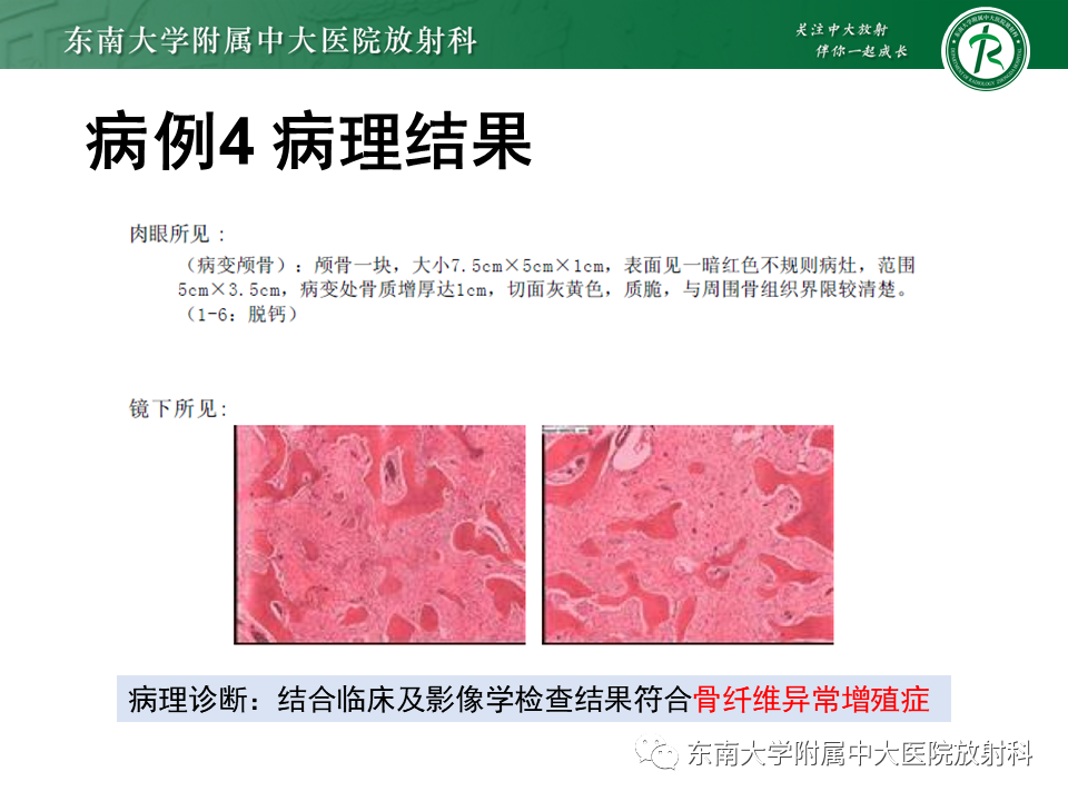 影像PPT - 【PPT】骨纤维异常增殖症-21
