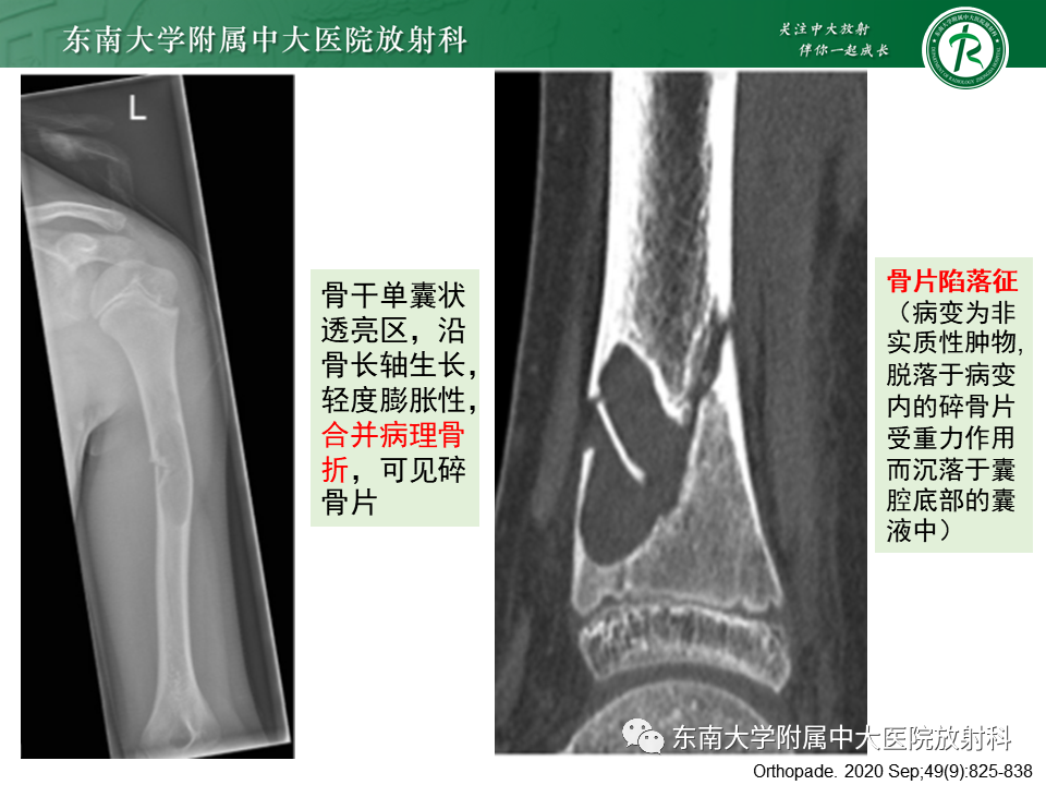 影像PPT - 【PPT】骨纤维异常增殖症-26