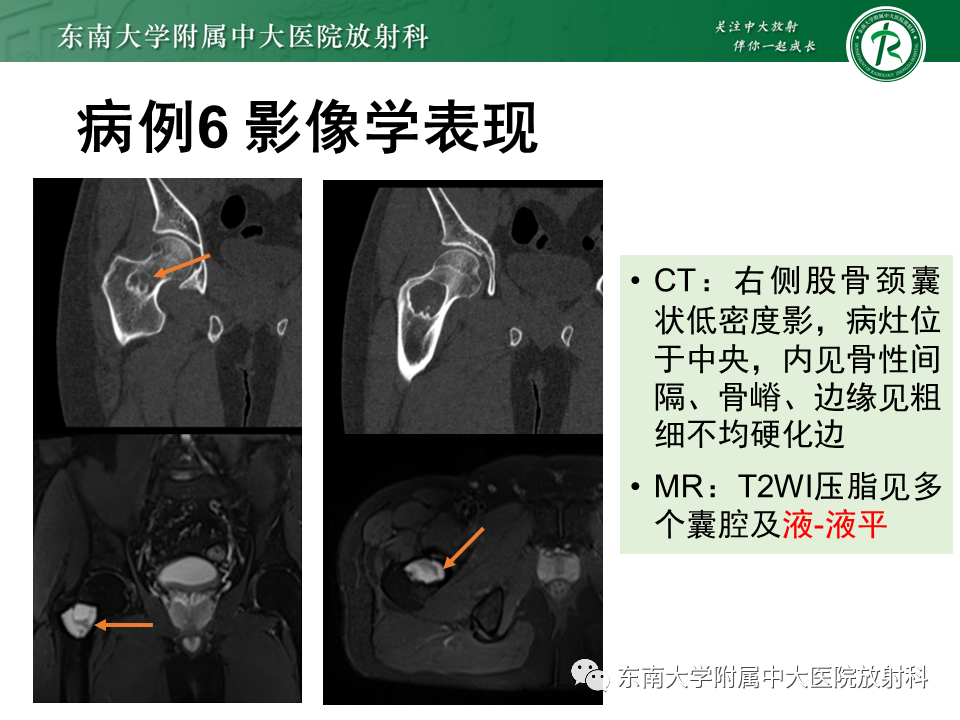 影像PPT - 【PPT】骨纤维异常增殖症-28