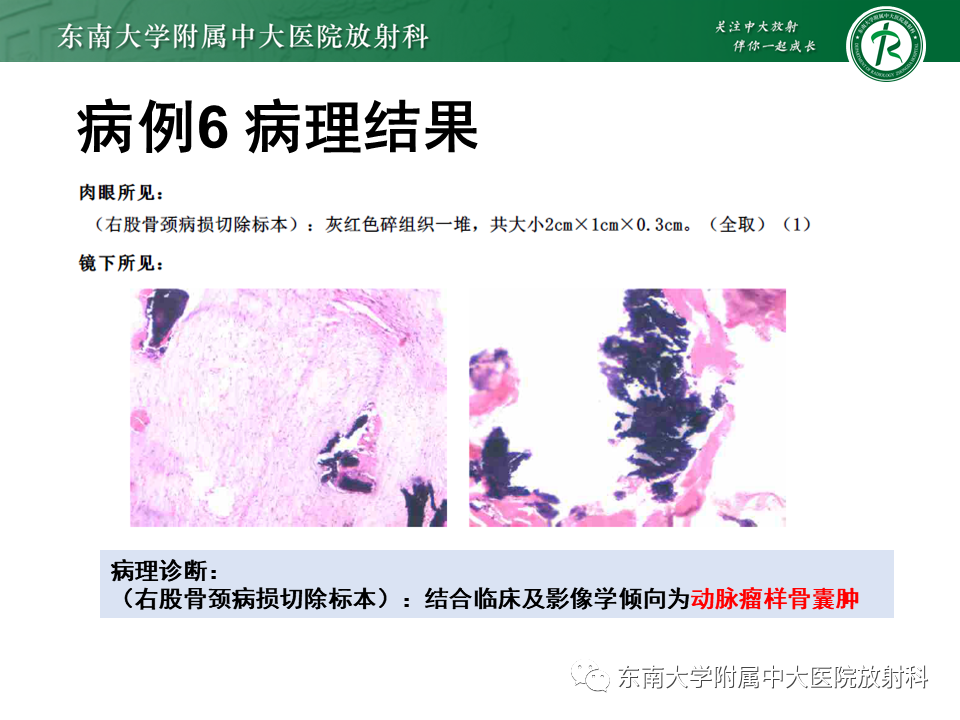 影像PPT - 【PPT】骨纤维异常增殖症-29