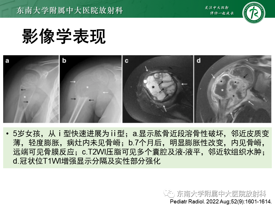 影像PPT - 【PPT】骨纤维异常增殖症-32