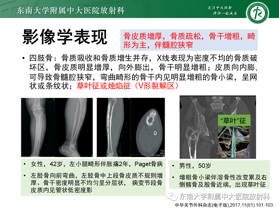 影像PPT - 【PPT】骨纤维异常增殖症-34