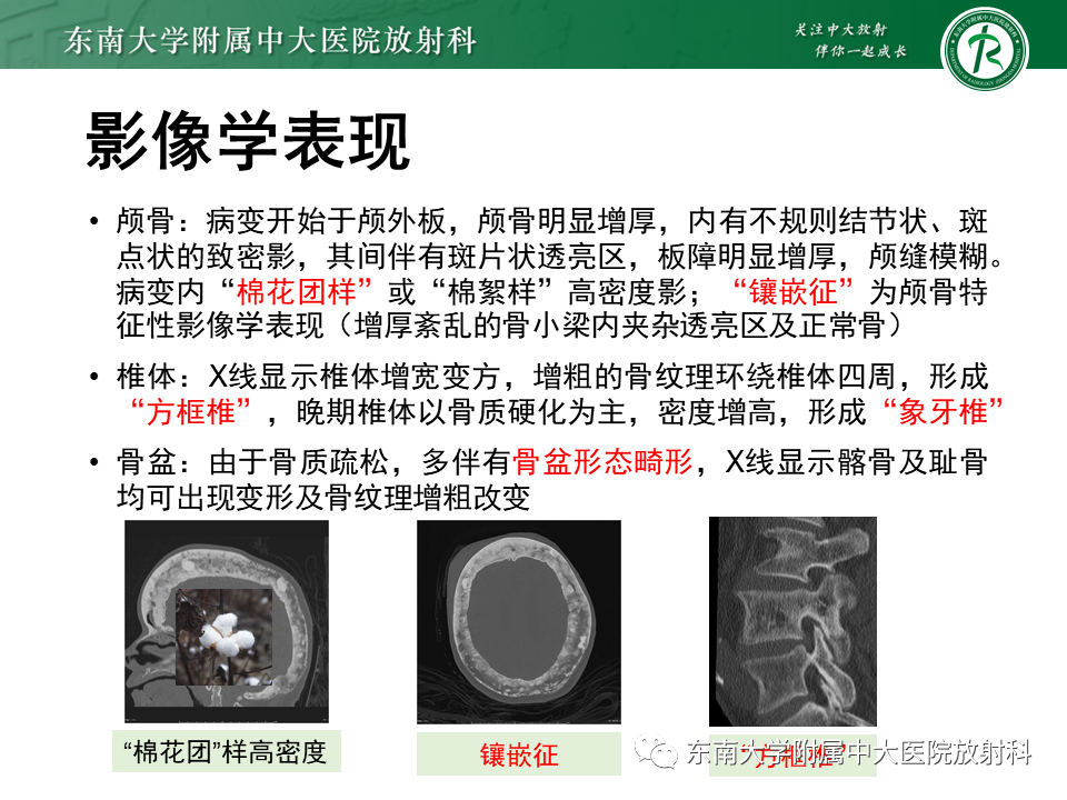 影像PPT - 【PPT】骨纤维异常增殖症-35