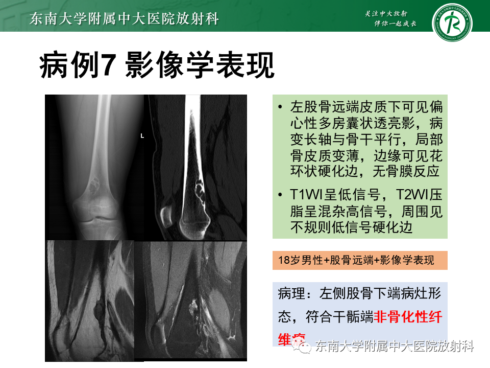 影像PPT - 【PPT】骨纤维异常增殖症-38