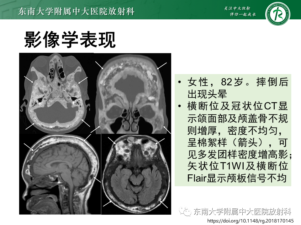 影像PPT - 【PPT】骨纤维异常增殖症-36