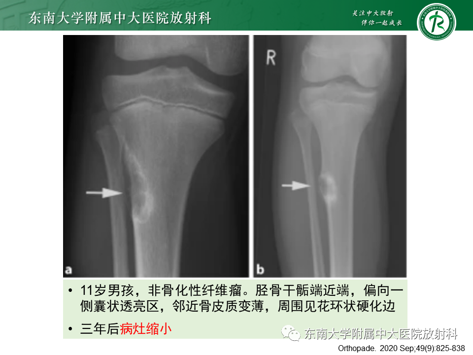 影像PPT - 【PPT】骨纤维异常增殖症-41