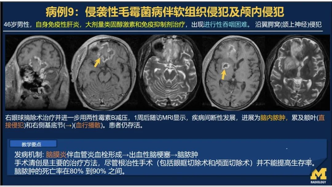 影像PPT - 【PPT】致命的真菌：头颈部侵入性真菌感染(双语)-4