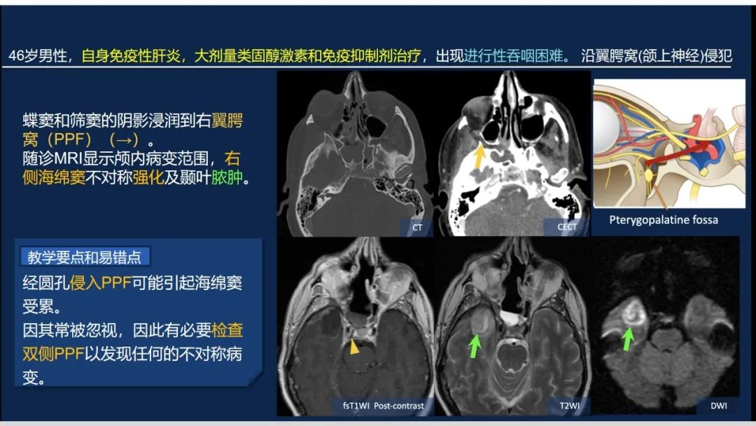 影像PPT - 【PPT】致命的真菌：头颈部侵入性真菌感染(双语)-2