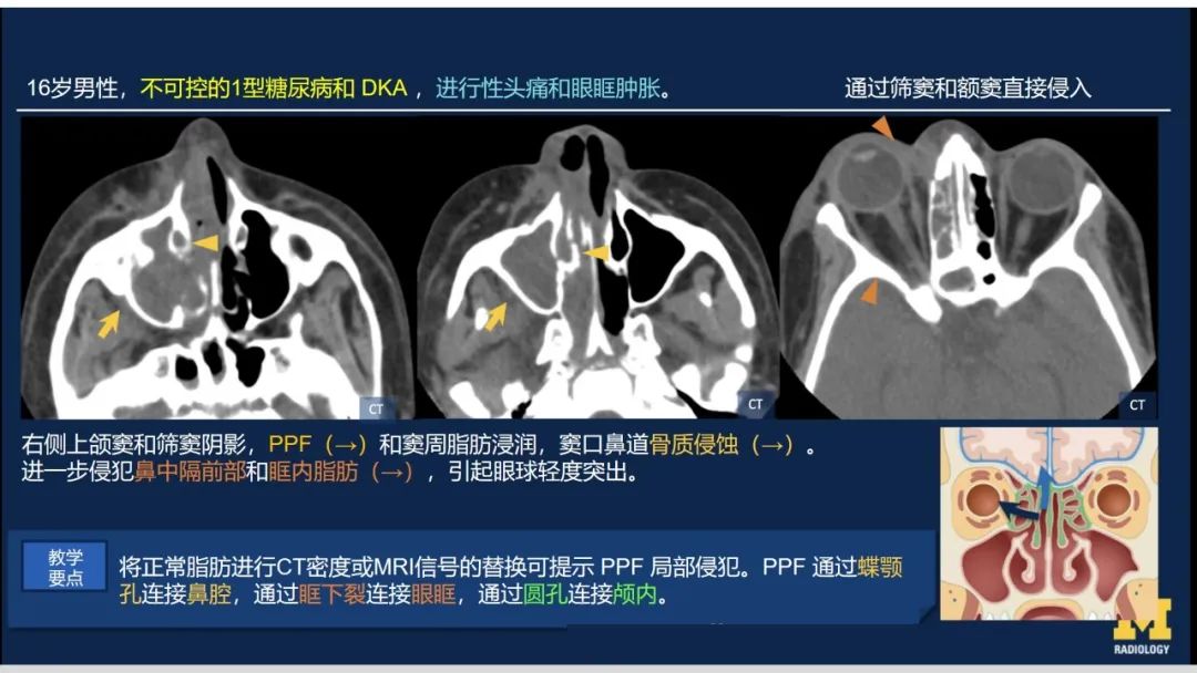 影像PPT - 【PPT】致命的真菌：头颈部侵入性真菌感染(双语)-6