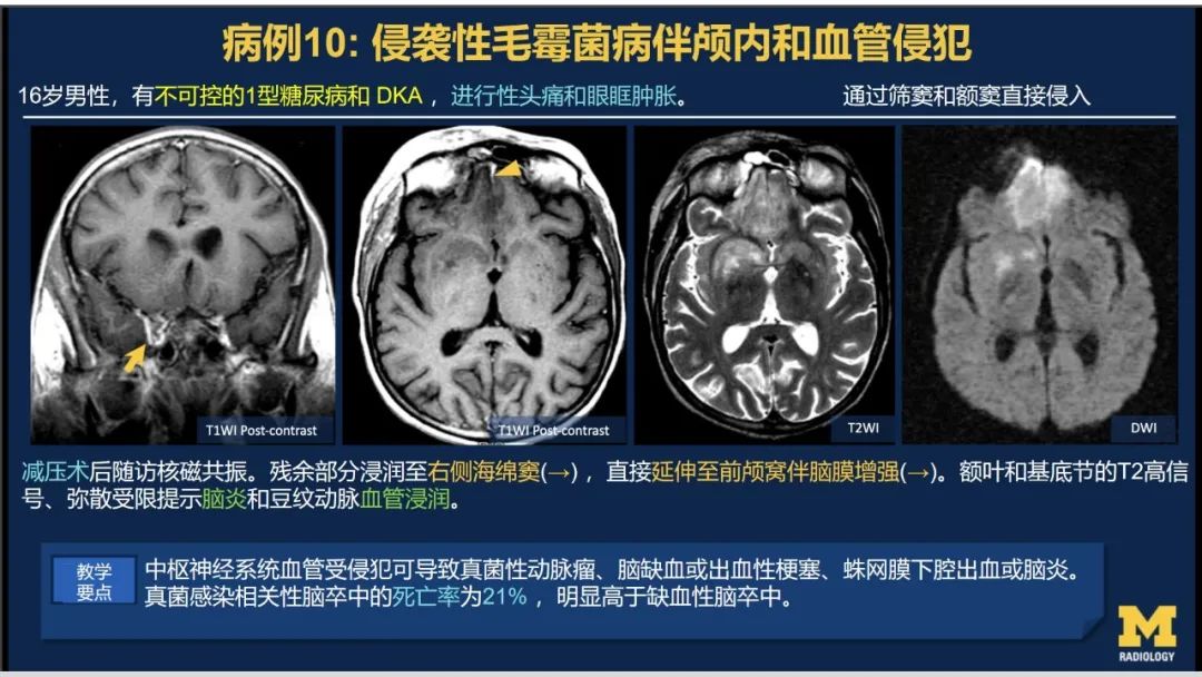 影像PPT - 【PPT】致命的真菌：头颈部侵入性真菌感染(双语)-8