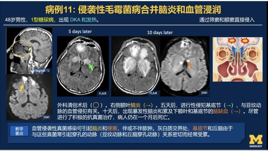 影像PPT - 【PPT】致命的真菌：头颈部侵入性真菌感染(双语)-10