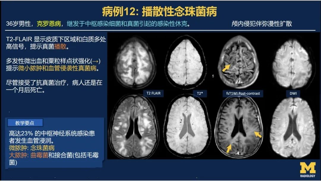 影像PPT - 【PPT】致命的真菌：头颈部侵入性真菌感染(双语)-12