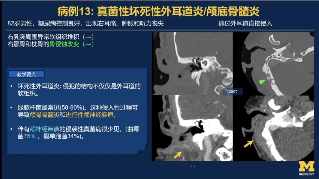 影像PPT - 【PPT】致命的真菌：头颈部侵入性真菌感染(双语)-14