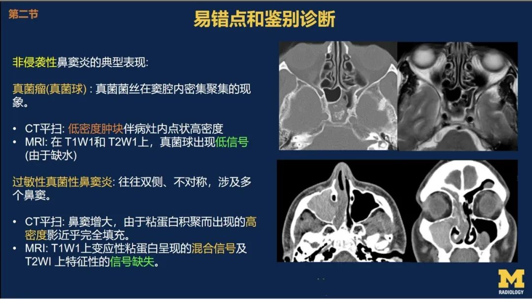影像PPT - 【PPT】致命的真菌：头颈部侵入性真菌感染(双语)-16