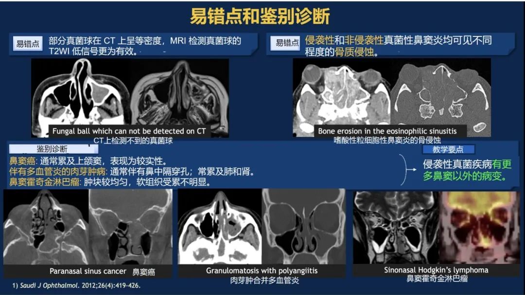 影像PPT - 【PPT】致命的真菌：头颈部侵入性真菌感染(双语)-18