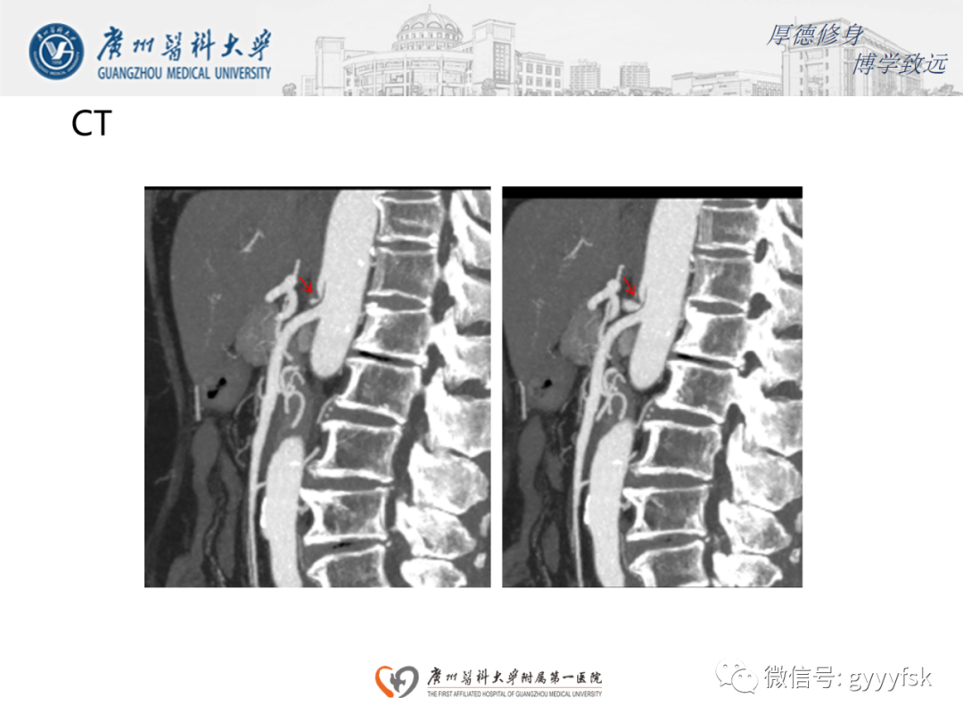 影像PPT - 【病例】正中弓状韧带压迫综合征1例CT影像-4