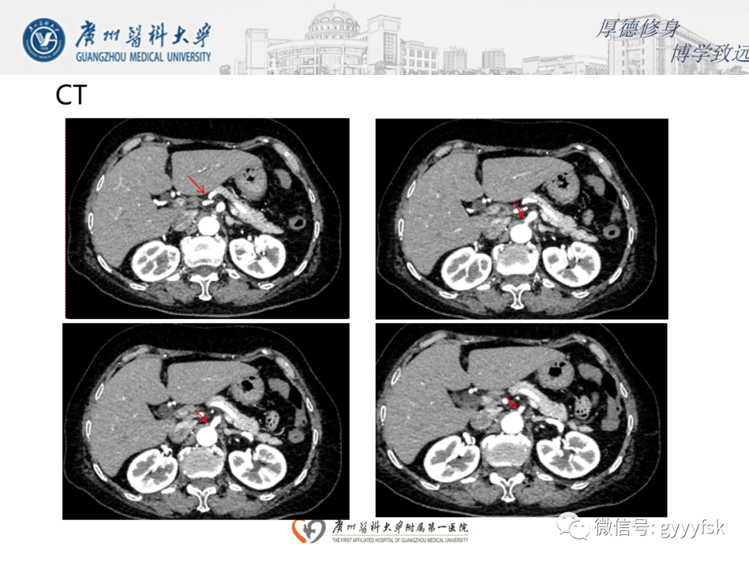 影像PPT - 【病例】正中弓状韧带压迫综合征1例CT影像-3