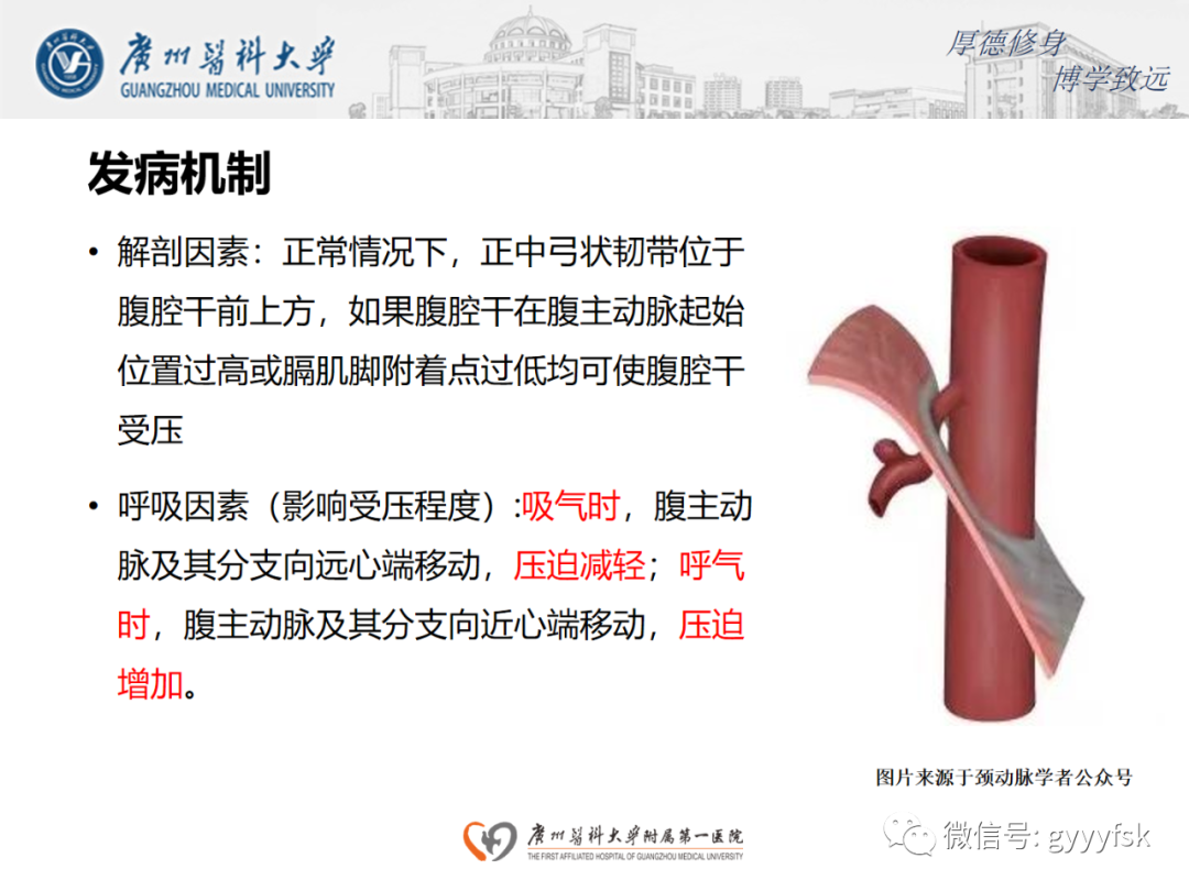 影像PPT - 【病例】正中弓状韧带压迫综合征1例CT影像-9
