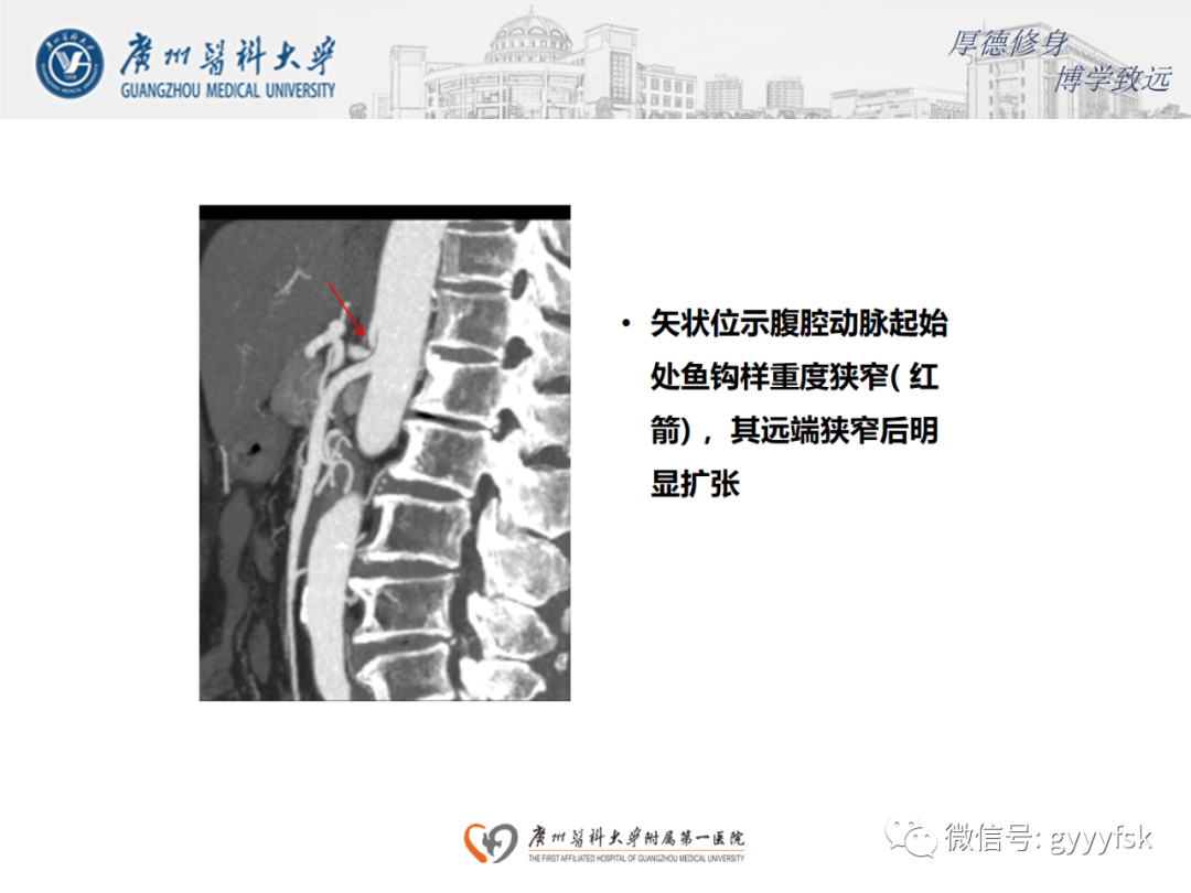 影像PPT - 【病例】正中弓状韧带压迫综合征1例CT影像-11