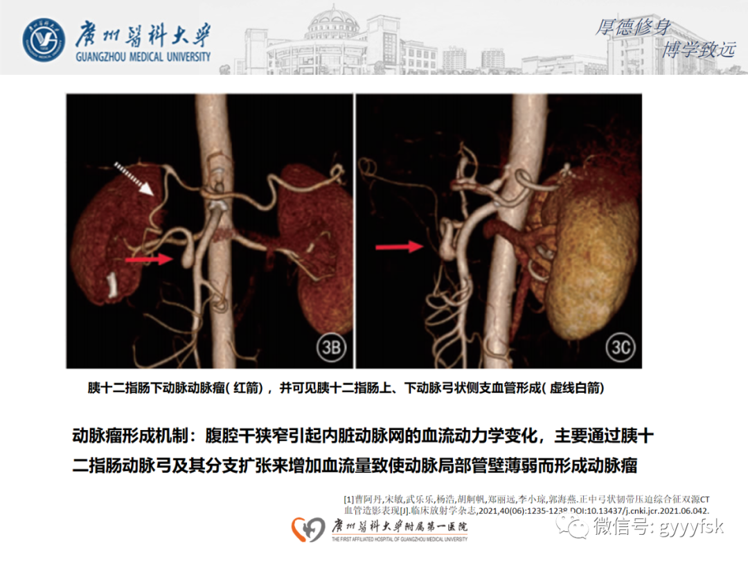 影像PPT - 【病例】正中弓状韧带压迫综合征1例CT影像-13