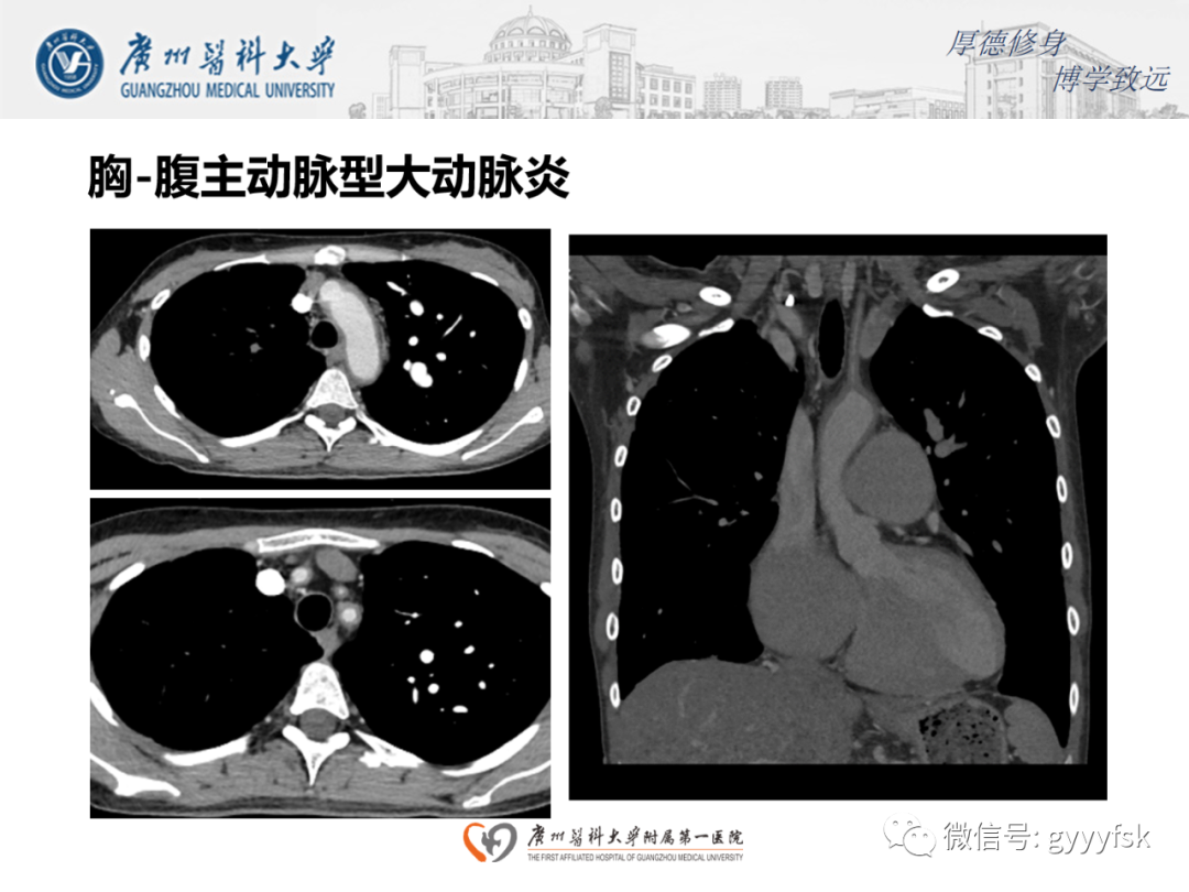 影像PPT - 【病例】正中弓状韧带压迫综合征1例CT影像-17