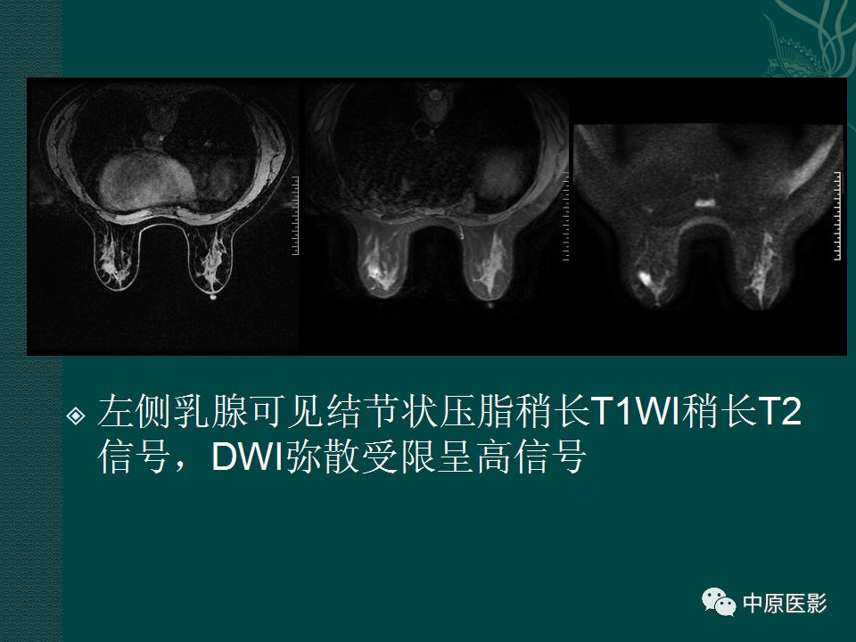 影像PPT - 【PPT】乳腺导管内乳头状瘤MRI表现-17