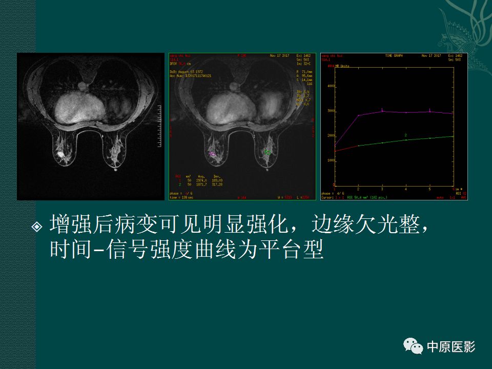 影像PPT - 【PPT】乳腺导管内乳头状瘤MRI表现-18