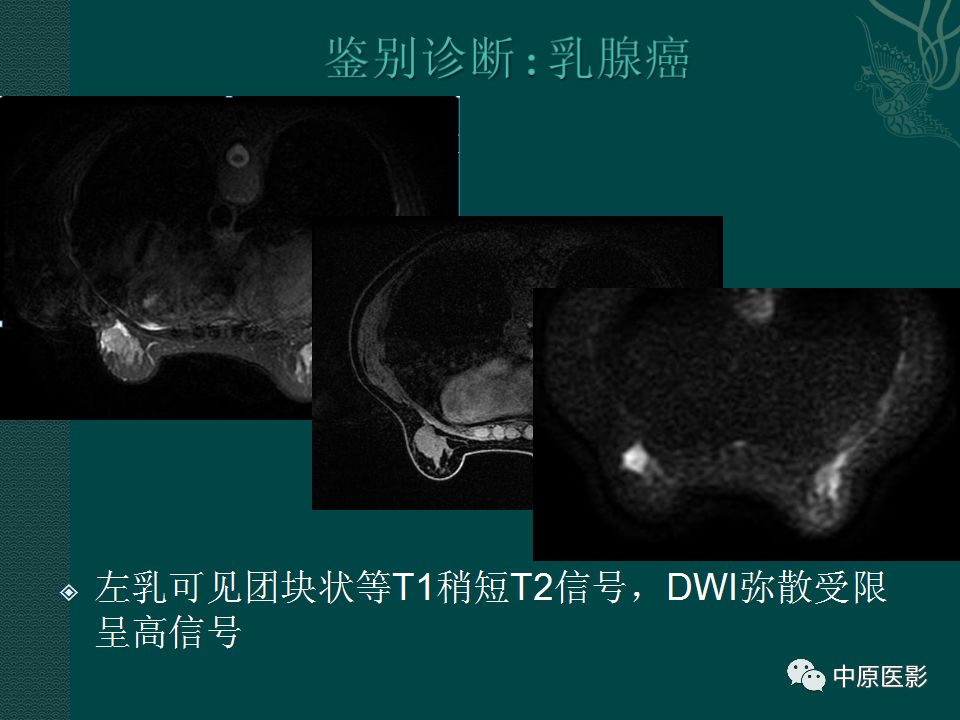 影像PPT - 【PPT】乳腺导管内乳头状瘤MRI表现-19