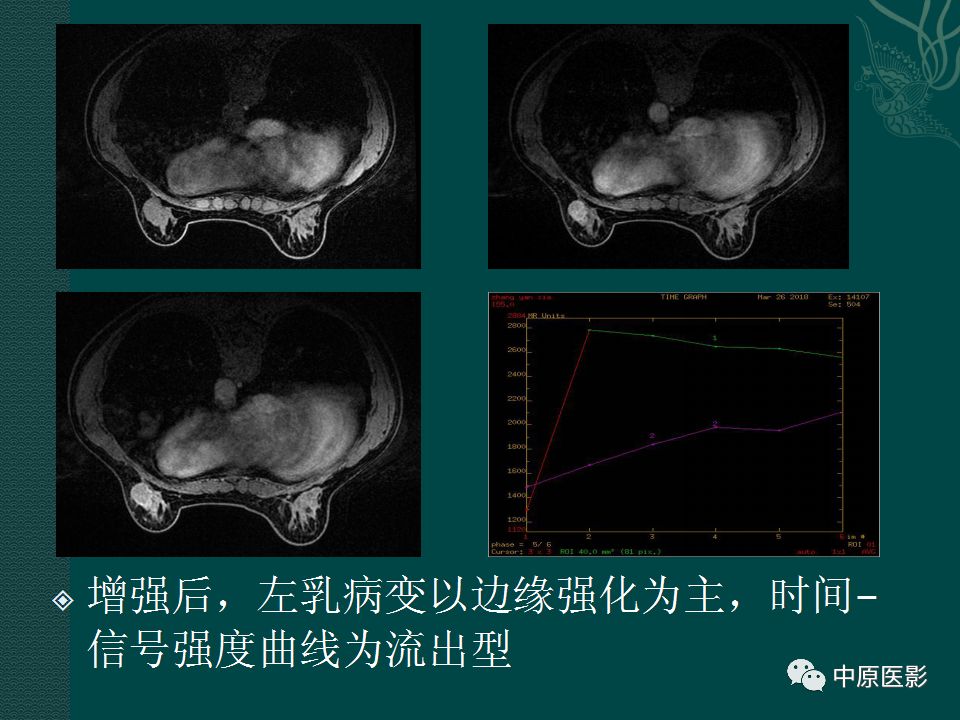 影像PPT - 【PPT】乳腺导管内乳头状瘤MRI表现-20