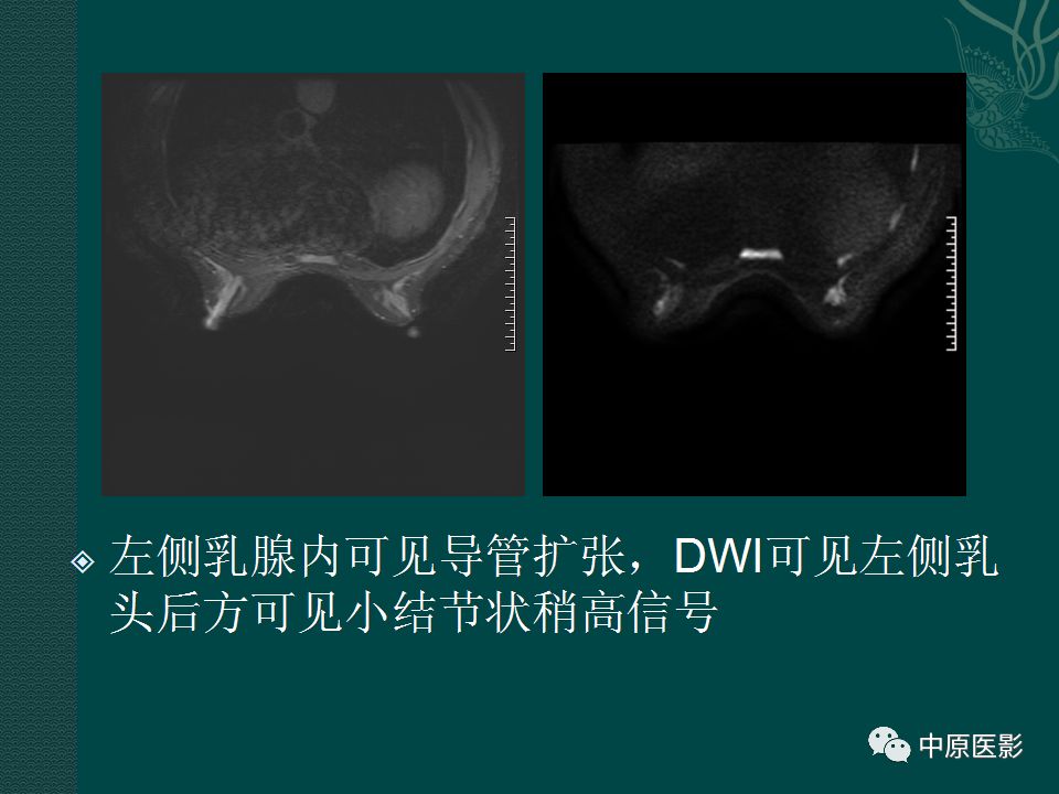 影像PPT - 【PPT】乳腺导管内乳头状瘤MRI表现-23