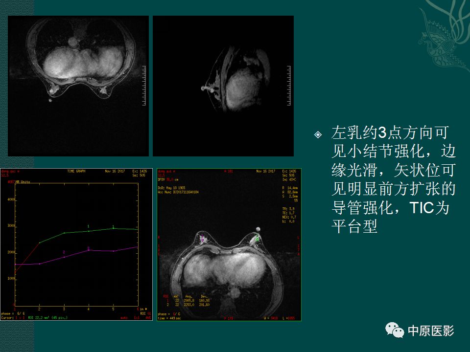 影像PPT - 【PPT】乳腺导管内乳头状瘤MRI表现-24