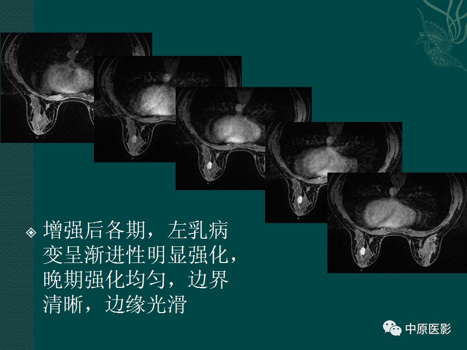 影像PPT - 【PPT】乳腺导管内乳头状瘤MRI表现-26
