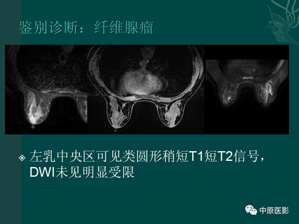 影像PPT - 【PPT】乳腺导管内乳头状瘤MRI表现-25