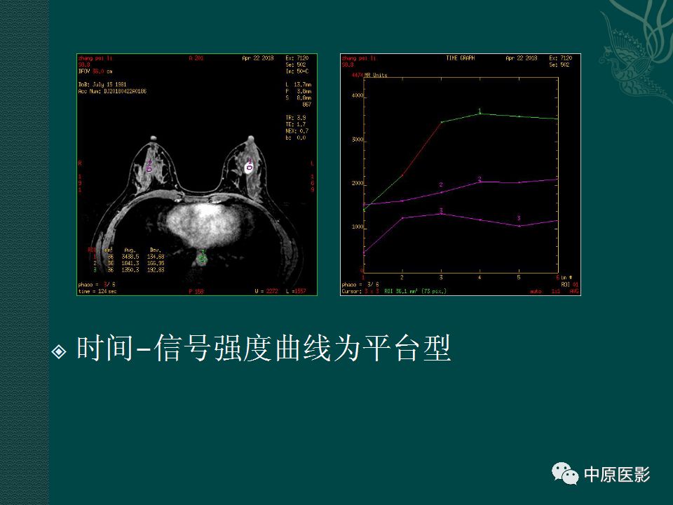 影像PPT - 【PPT】乳腺导管内乳头状瘤MRI表现-27