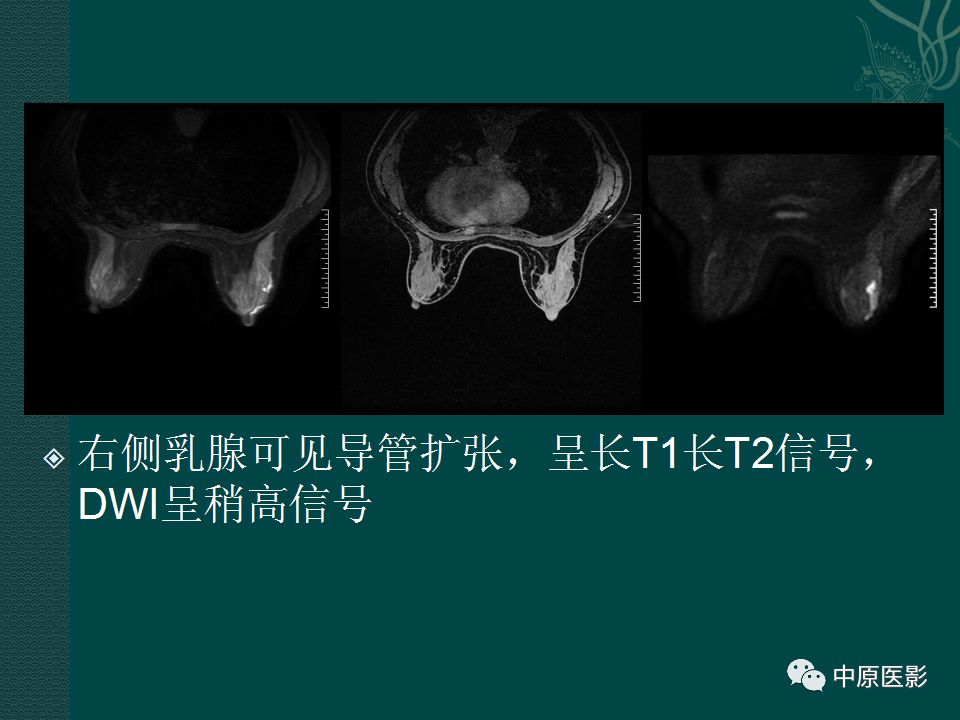 影像PPT - 【PPT】乳腺导管内乳头状瘤MRI表现-30