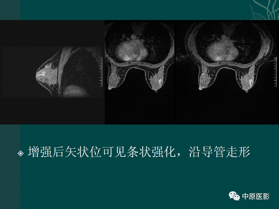 影像PPT - 【PPT】乳腺导管内乳头状瘤MRI表现-31