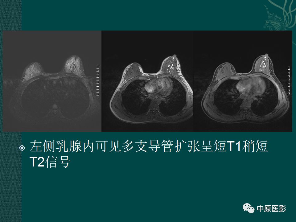 影像PPT - 【PPT】乳腺导管内乳头状瘤MRI表现-33