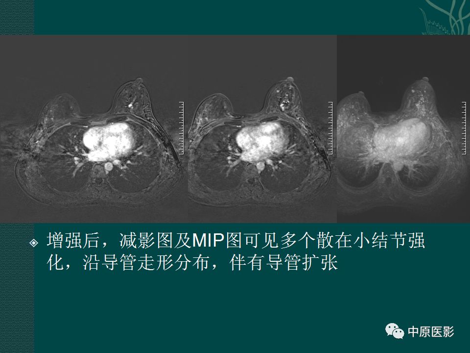 影像PPT - 【PPT】乳腺导管内乳头状瘤MRI表现-34
