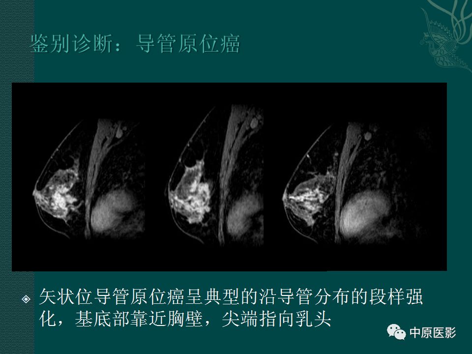 影像PPT - 【PPT】乳腺导管内乳头状瘤MRI表现-35