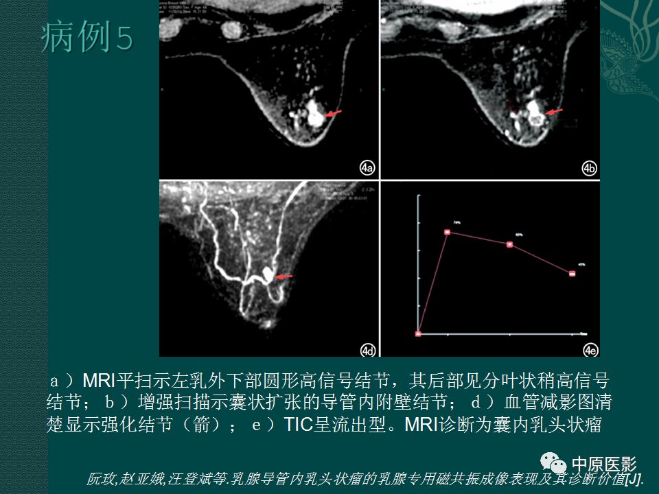 影像PPT - 【PPT】乳腺导管内乳头状瘤MRI表现-37