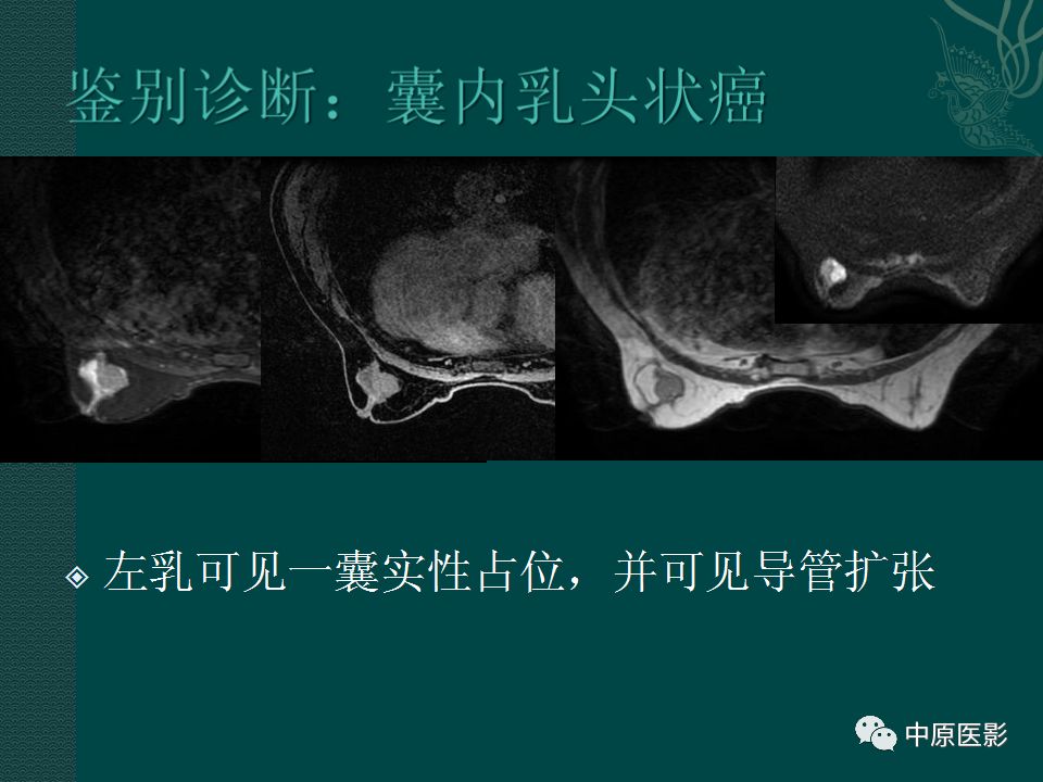影像PPT - 【PPT】乳腺导管内乳头状瘤MRI表现-38