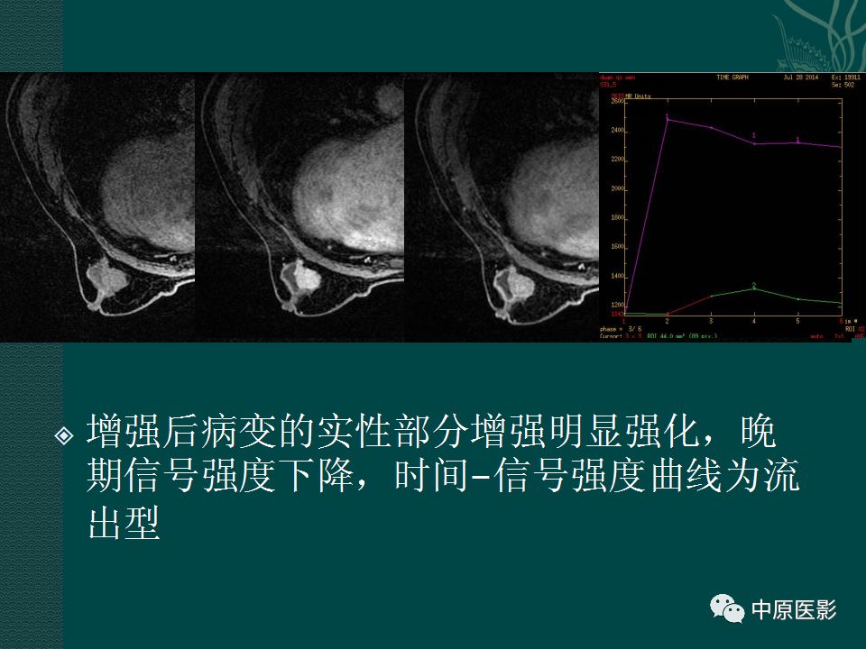 影像PPT - 【PPT】乳腺导管内乳头状瘤MRI表现-39
