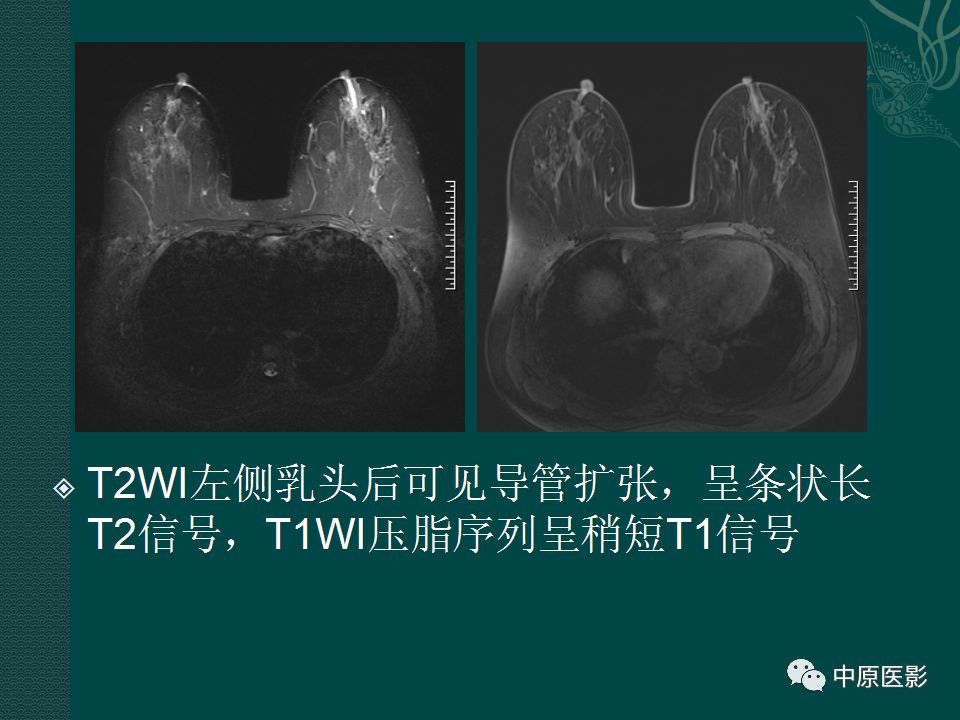 影像PPT - 【PPT】乳腺导管内乳头状瘤MRI表现-42