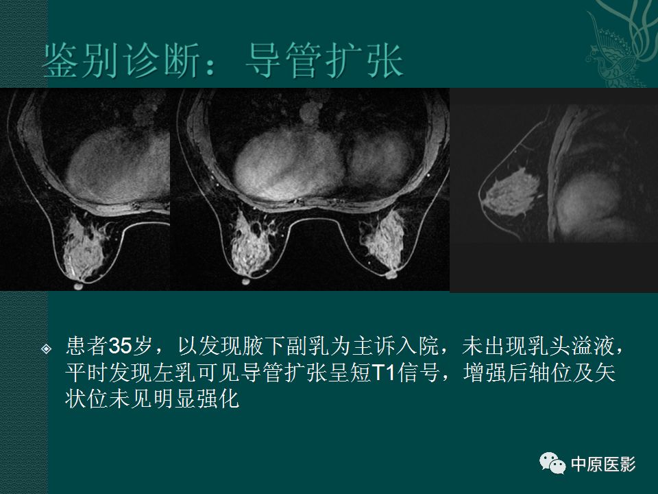 影像PPT - 【PPT】乳腺导管内乳头状瘤MRI表现-44
