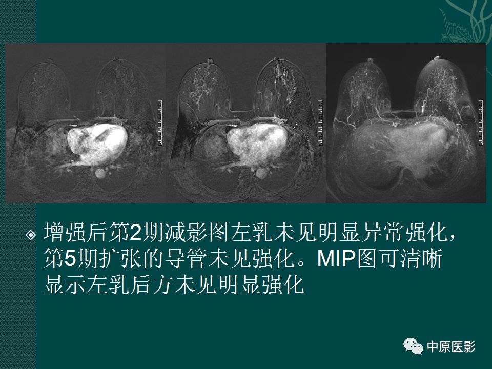 影像PPT - 【PPT】乳腺导管内乳头状瘤MRI表现-43