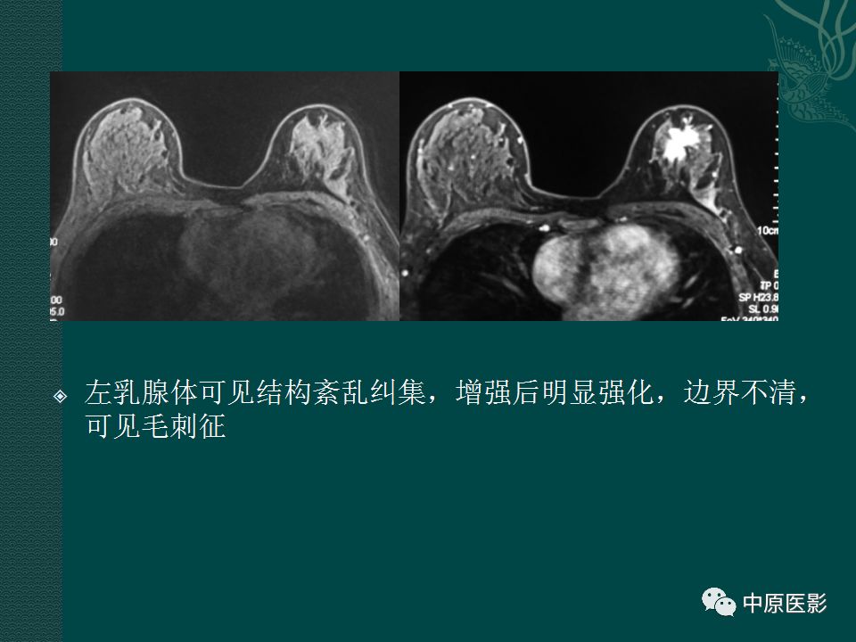 影像PPT - 【PPT】乳腺导管内乳头状瘤MRI表现-46