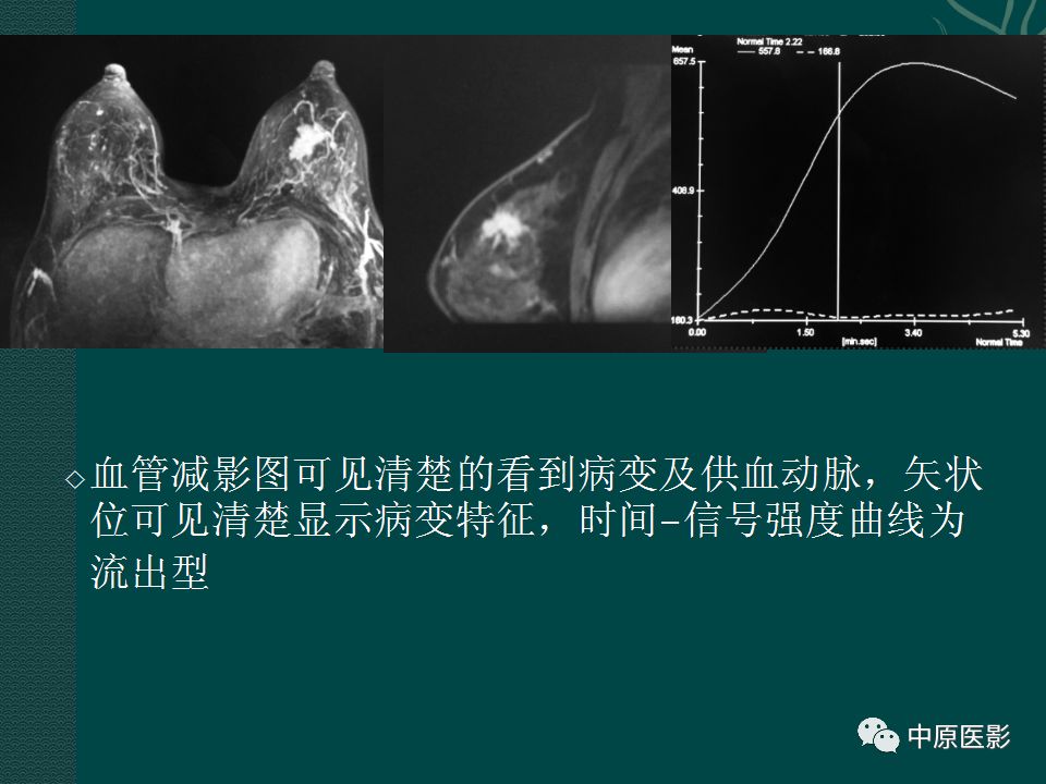 影像PPT - 【PPT】乳腺导管内乳头状瘤MRI表现-47
