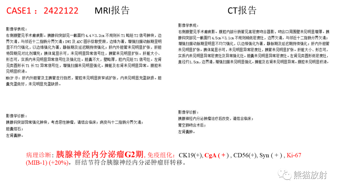 影像PPT - 【病例】胰腺神经内分泌肿瘤2例CT及MR影像-16