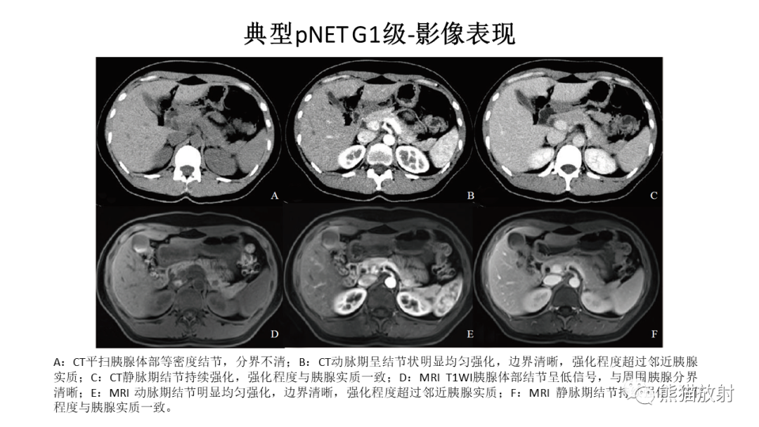 影像PPT - 【病例】胰腺神经内分泌肿瘤2例CT及MR影像-24