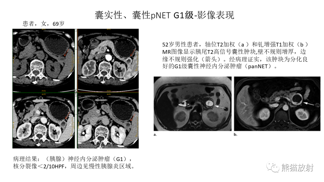 影像PPT - 【病例】胰腺神经内分泌肿瘤2例CT及MR影像-25